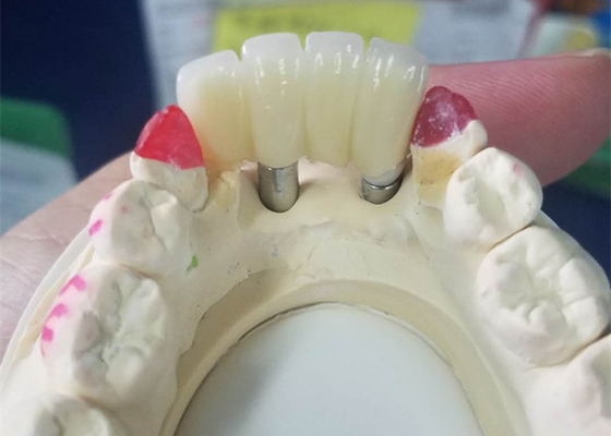 Strong Ti Base Milling Dental Implant Crowns Tooth Supported Bridge