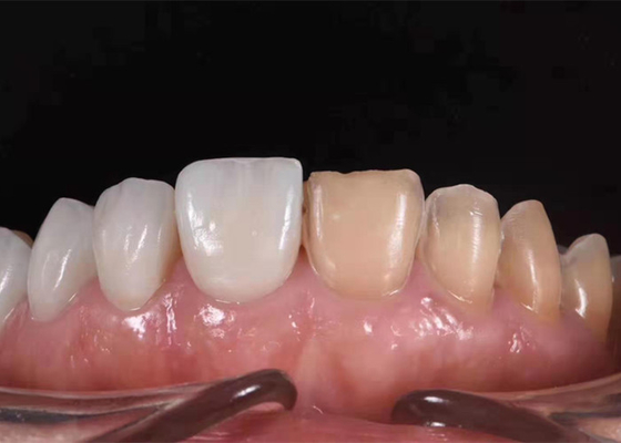 0.3MM Whitening Ceramic Dental Crown To Replace Unhealthy Teeth