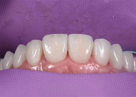 0.3MM Whitening Ceramic Dental Crown To Replace Unhealthy Teeth