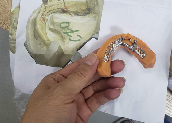 3D Printing Removable Dental Crown Framework Models For Dentistry