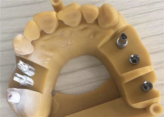 Digital Biocompatibility PFM Dental Crown 3D Printing Temporary Crowns