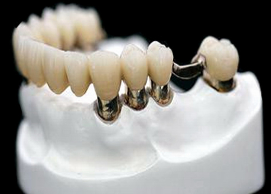 CO CR MK1 Precision Attachment Denture Corrosion Resistance