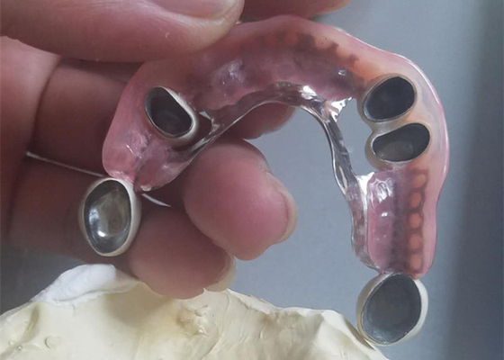 Flexible Durable Precision Attachment Denture Corrosion Resistant