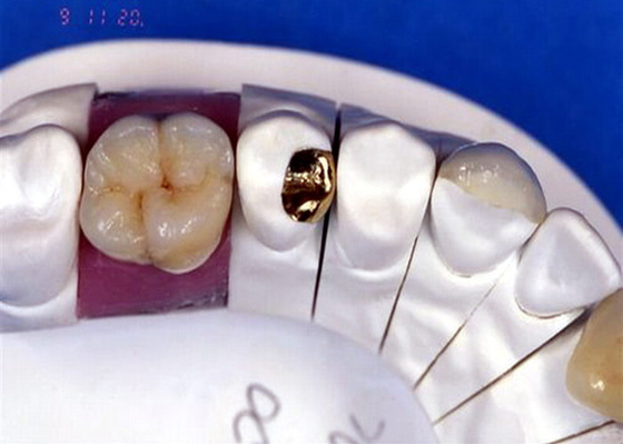 PFM Porcelain Dental Crown