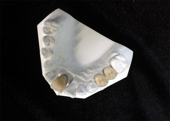 High Stability Ceramic Dental PFM Crown Natural Tooth Stain Resistant