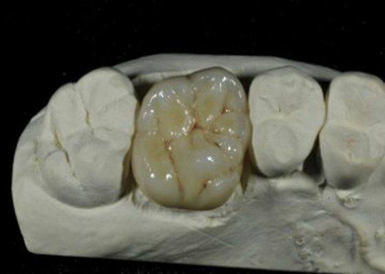 CE ISO Flexible Porcelain Dental Crown For Back Teeth Restoration