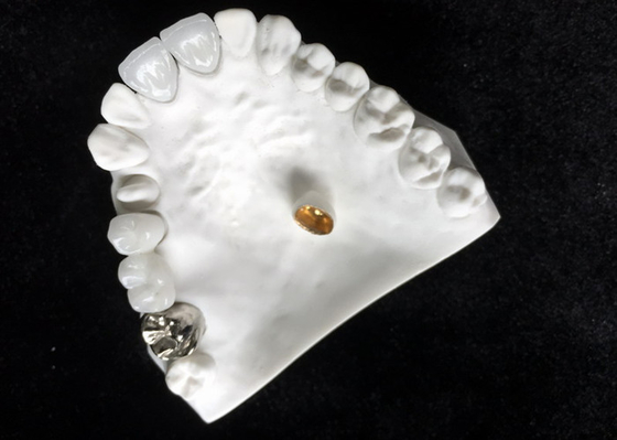 Good Biocompatibility Porcelain Dental Crown High Tech Biological Material