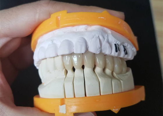 Custom Size PFM Ceramic Crowns For Posterior And Anterior Teeth