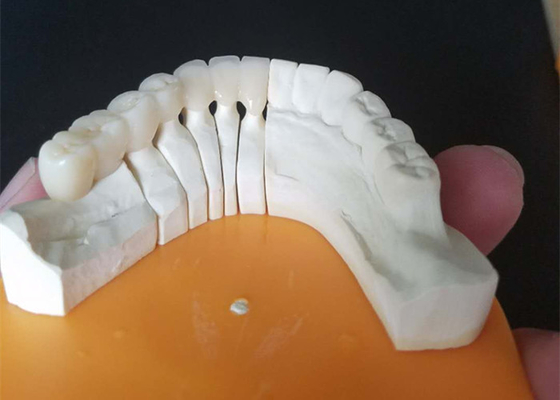 Custom Size PFM Ceramic Crowns For Posterior And Anterior Teeth