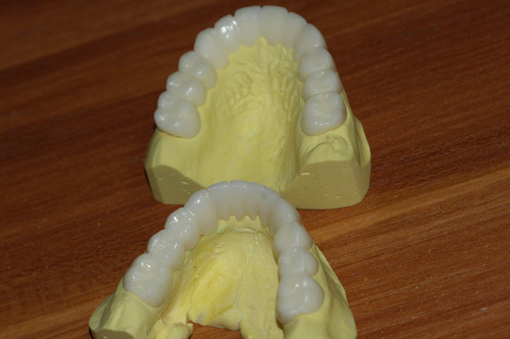 Temporary PFM Dental Crown