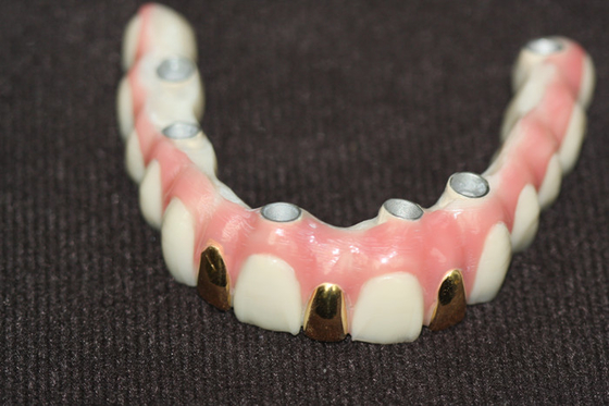Precision Digital 3D Printing Dental Implant Bar Metal Based