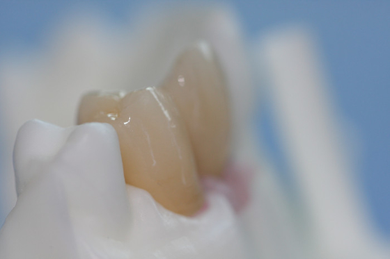 Removable Pure Titanium Dental Implant Bar Custom Abutment