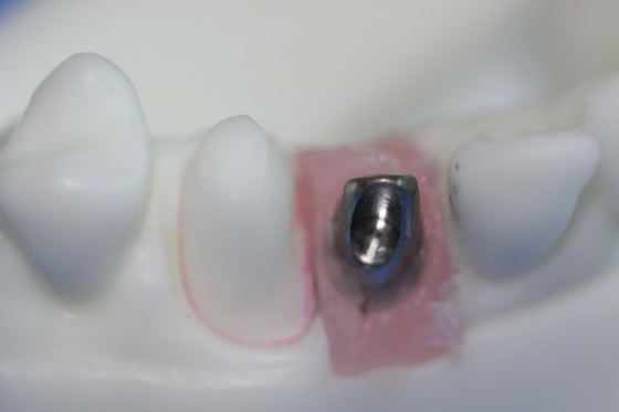 Removable Pure Titanium Dental Implant Bar Custom Abutment