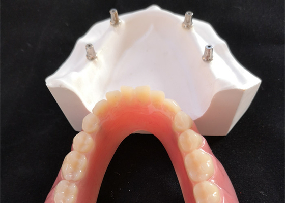 Comfortable CAD CAM Dental Implant Overdenture Easy Maintain