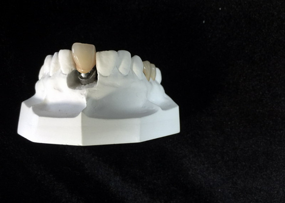 Custom Dental Implant Locators High Stability Bar Attachment Denture