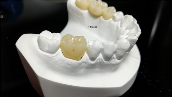 Ceramic Dental Crown,Zirconia Dental Crowns