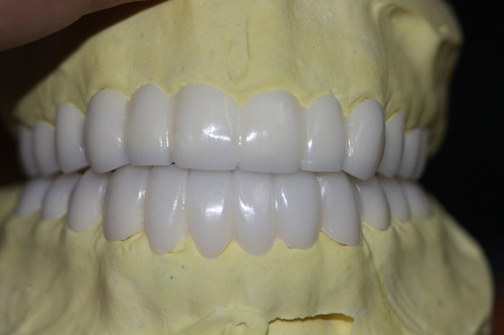 Temporary PFM Dental Crown