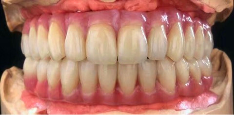 Zirconia All-Ceramic Teeth Crowns & Bridges