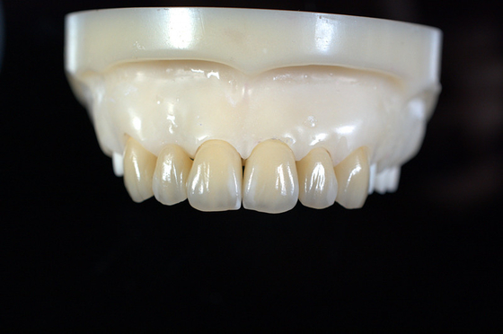 Zirconia All-Ceramic Teeth Crowns & Bridges