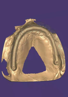 Customized 3D Model Zirconia Crown Offering Long-lasting Durability Designed To Meet The Needs Of Dental Professionals And Laboratories