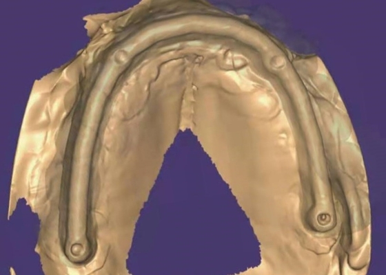 Zirconia Dental Crown: Natural-looking Teeth, Durable &amp; Secure