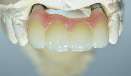 Strong Ti Base Milling Dental Implant Crowns Tooth Supported Bridge