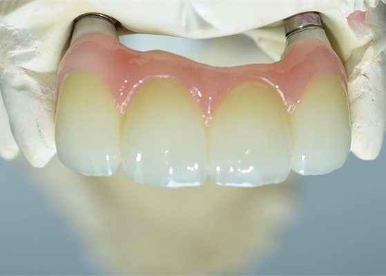 Strong Ti Base Milling Dental Implant Crowns Tooth Supported Bridge