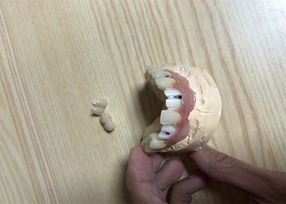 Accurate Biocompatibility Dental Implant Attachments Tooth Implant Crown