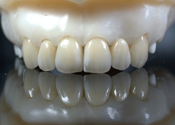 EMAX    Durablity CAD/CAM Dental Composite Veneers Highly Detailed Accurate