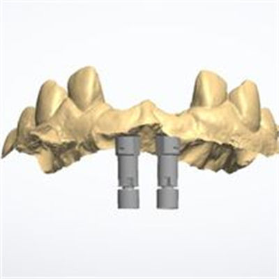 Customized 3D Model Zirconia Crown Offering Long-lasting Durability Designed To Meet The Needs Of Dental Professionals And Laboratories