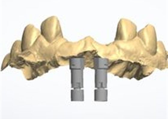 Natural-looking Zirconia Dental Crown with Excellent Biocompatibility and Cementable 3D Model
