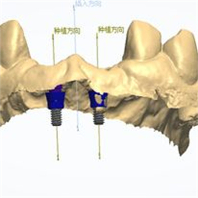 Precise CAD/CAM Design Zirconia Dental Crown for Fitment