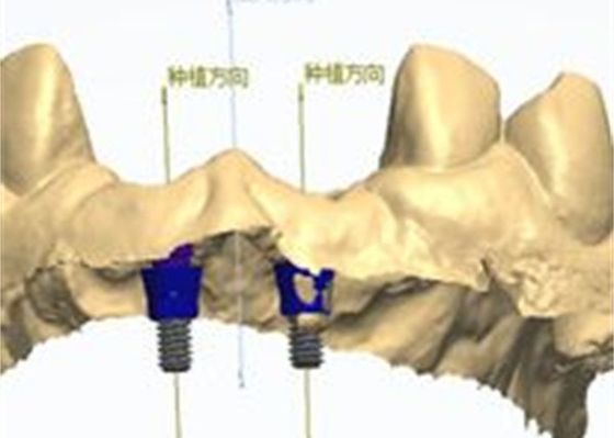 Natural-looking Zirconia Dental Crown with Excellent Biocompatibility and Cementable 3D Model
