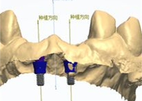 Precise CAD/CAM Design Zirconia Dental Crown for Fitment
