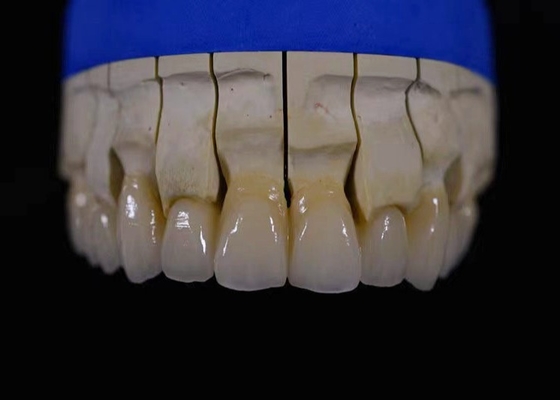 Full Mouth Zirconia Dental Crown Restoration Zirconia Fixed Bridge Chemical Resistance