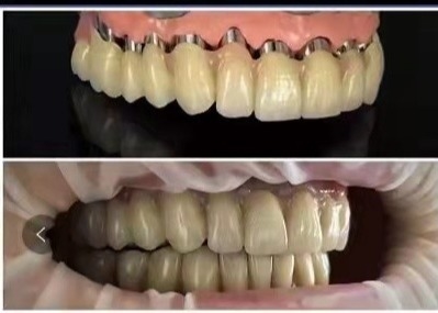 CAD CAM PFM Implant Crown Bridge Telescopic Crown Dental 3D Printed Models