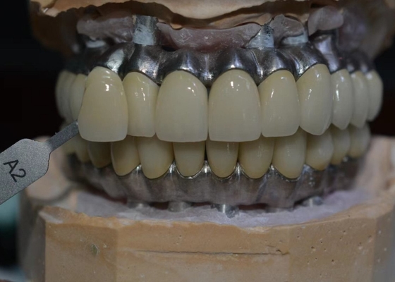 Precision-Crafted Dental Implant Crowns for Comfort &amp; Confidence