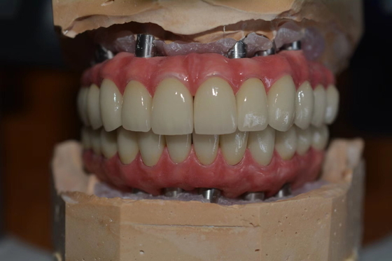Precision-Crafted Dental Implant Crowns for Comfort &amp; Confidence