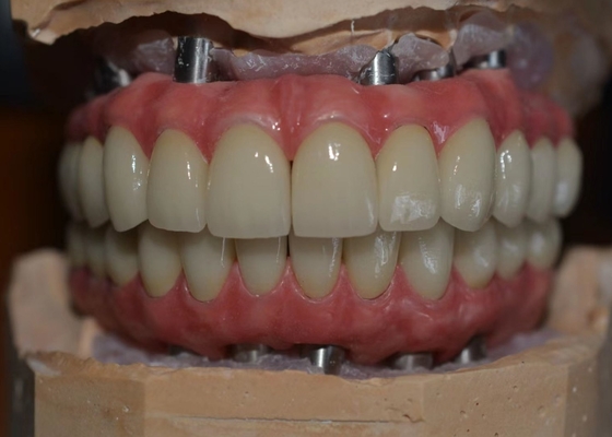 Corrosion Resistant Co Cr Implant Supported Metal Crown Biological Material