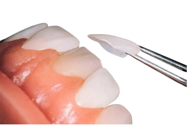 Custom OEM Dental Porcelain Veneer Firm Wear Resistant For Dental Restoration