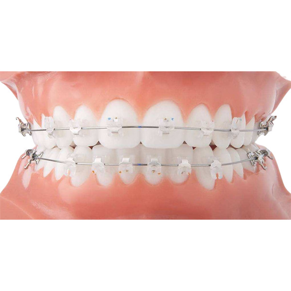 Easy Clean Orthodontic Ceramic Bracket Beautiful Fixed Orthodontic ...