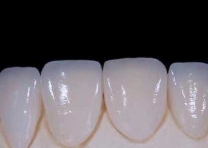 EMAX Durablity CAD/CAM Dental Composite Veneers Highly Detailed Accurate